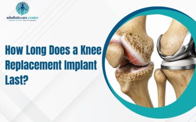 How Long Does a Knee Replacement Implant Last?